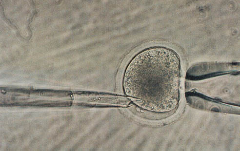 1990년대 개발된 ICSI 시술 장면. 난자를 오른쪽 지지대에 고정시킨 후 왼쪽 가는 유리관을 통해 정자를 난자에 직접 주입한다. 수정에 정자 하나만 필요한 획기적 방식이다.