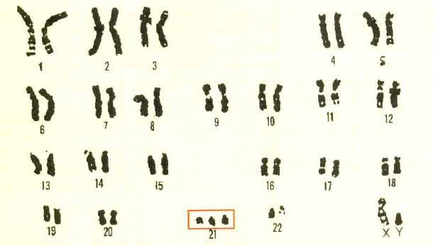 다운증후군 환자의 염색체 모습.21번 염색체가 정상인보다 1개많다.셀레라가 노리는 주요 목표는 유전병과 관련된 유전자의 구조를 밝혀 특허를 출원하는 일이다.