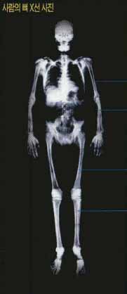 사람의 뼈 X선 사진