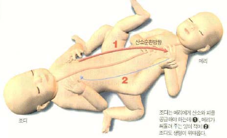 조디는 메리에게 산소와 피를 공급해야 하는데(1),메리가 되돌려주는 양이 적어 (2)조디도 생명이 위태롭다.