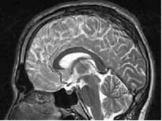 자기공명영상장치(MRI)는 초전도 현상을 이용한 대표 적인 사례.