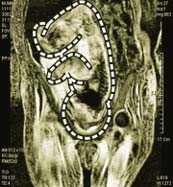 미라 복부의 MRI 사진