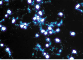 RNA 간섭을 처리한 폐암세포. RNA 간섭을 처리하면 폐암세포의 사멸이 일어남을 알 수 있다.