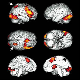 전북대 재활의학과 김연희 교수팀이 우리말로 생각할 때 활성화되는 뇌 부위를 FMRI로 찍은 모습. 이는 지난 2001년 '국제인간뇌지도학회'에서 발표됐다.