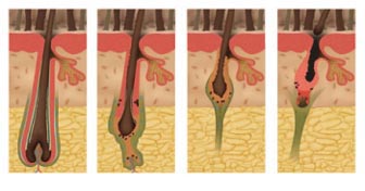 1. 생장단계. 케라틴 단백질이 계쏙 만들어지면서 하루에 0.3~0.5mm씩 자란다. 2. 퇴행단계. 더이상 자라지 않고 모낭이 상승하기 시작한다. 3. 탈모단계. 모낭이 두피 표면 근처까지 올라온다. 4. 머리카락이 완전히 빠지고 새로운 생장단계로 접어든다.