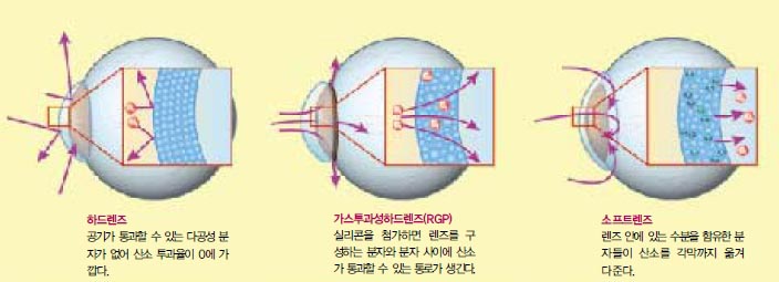 콘택트렌즈의 종류