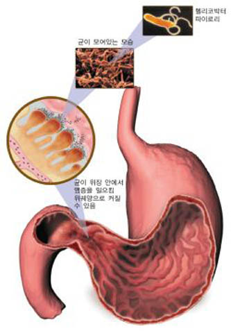 헬리코박터의 감염과 발병 과정