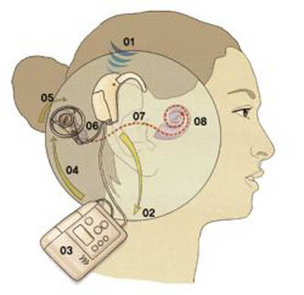 인공와우가 작동하는 원리^와우(달팽이관)가 손상된 사람을 다시 들을 수 있게 해주는 인공와우는 대표적인 뇌-기계 접속기술이다. 마이크(01)로 소리가 들어오면 언어합성기로 전달해(02) 코드신호로 바꾼 다음(03) 발신기로 보낸다(04). 발신기가 이 신호를 피부에 삽입된 수화기로 보내면(05) 수화기가 전기신호로 바꿔(06) 인공와우로 전달한다(07). 인공와우의 전극이 전기신호를 받아 청신경을 자극해(08) 소리를 듣게 된다.