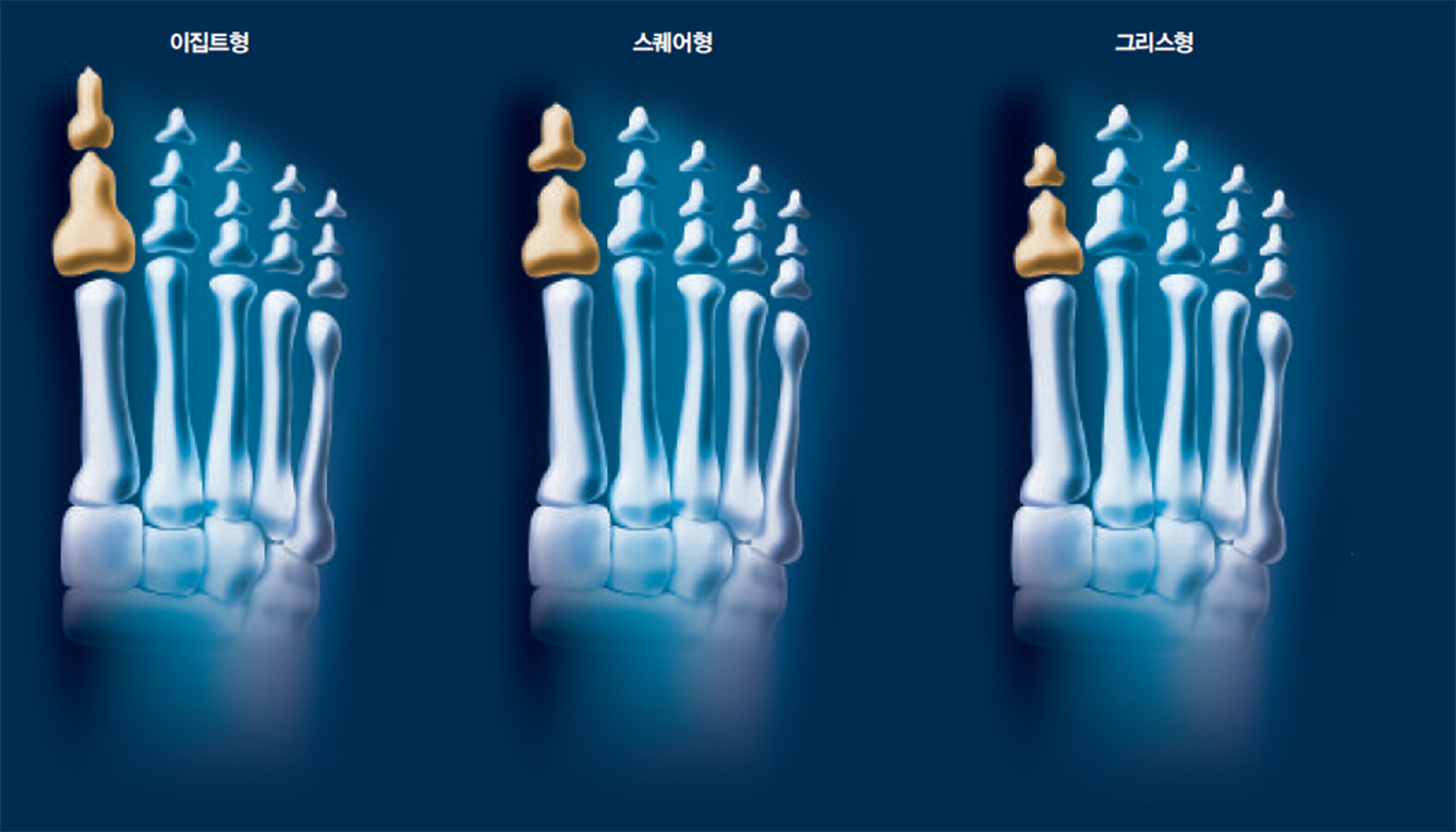 발가락 길이로 구분한 발 형태^엄지발가락과 둘째발가락 길이로 발 형태를 나눈다. 엄지발가락이 둘째발가락보다 길면 이집트형, 같으면 스퀘어형, 짧으면 그리스형이다.