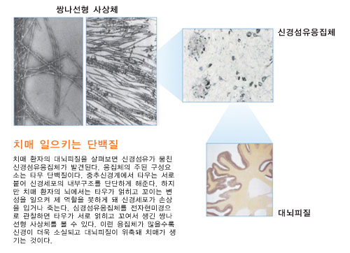 치매 일으키는 단백질