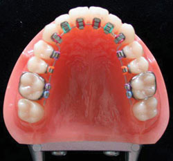치아 안쪽에 부착하는 설측 교정장치는 사회할동에 지장 없이 치아를 교정하고 싶은 사람들이 선택한다.