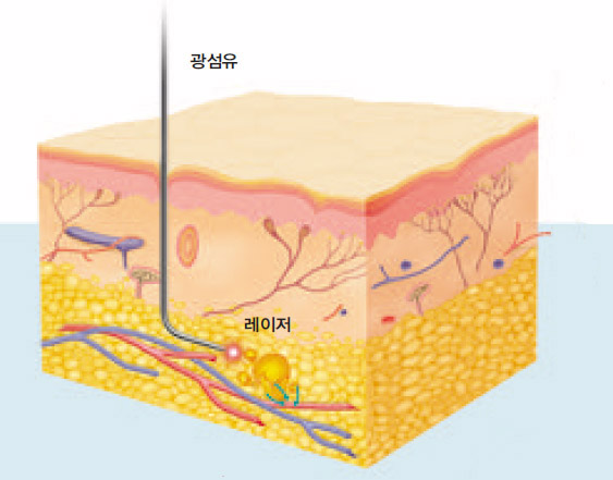 레이저 지방흡입술