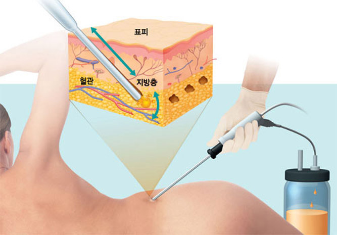 일반 지방흡입술