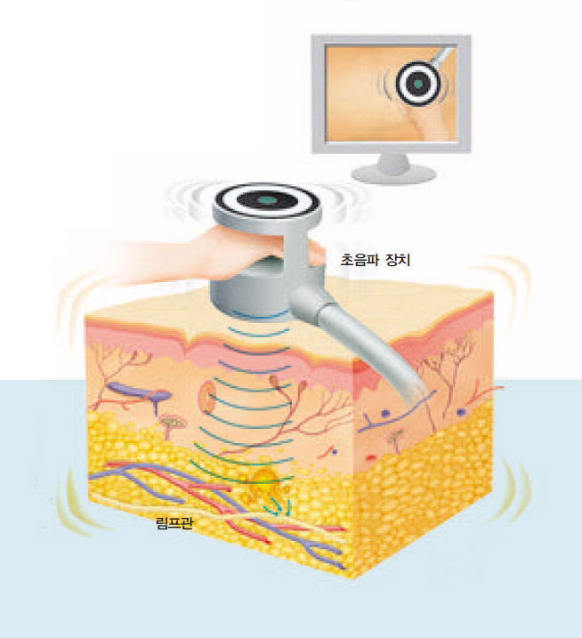 초음파 지방흡입술