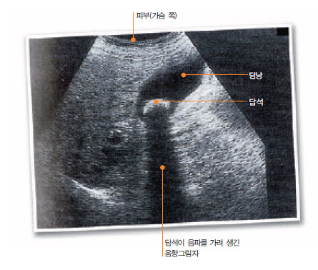 현재 사용하는 초음파검사는 주로 밝기에 따른 영상을 보여주는 B모드를 사용한다. 사진은 담낭에 있는 담석을 찾앙낸 초음파검사 결과다.