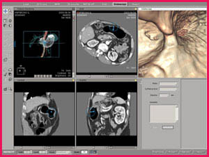 다중검출CT로 찍은 수많은 영상으로 가상내시경을 구현할 수 있다. 마치 내시경으로 위 속을 들여다보는 것 같은 장면(맨 오른쪽 위)이 연출된다.