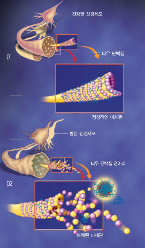 정상적인 타우 단백질은 신경세포 안에서 영양이 오가는 미세관의 형태를 유지한다(01 ). 그러나 C단 단백질이 신경세포핵에 들어가면 타우 단백질을 엉겨붙게 해 미세관을 손상시킨다. 미세관 손상으로 영양 공급이 끊긴 신경세포가 병들면서 치매가 발생한다(02). 자체 독성과 함께 C단 단백질이 치매를 유발하는 한 원인이다.