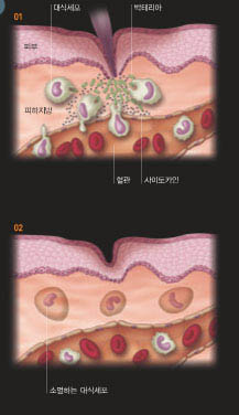 01몸 속으로 박테리아가 침입하면 대식세포 안에 있는 유전자인 NF-kB가 항균 단백질인‘사이토카인’을 분비해 면역반응을 일으킨다. 02박테리아가 퇴치되면 대식세포 내의 또 다른 유전자인 AP-1이 NF-kB의 활동을 억제해 면역반응을 중단시킨다. 임무를 마친 대식세포는 자연적으로 소멸한다.