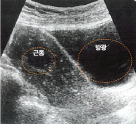 아랫배가 뻐근하고 생리 양이 많아 산부인과를 찾은 한 40대 여성의 초음파검사 결과 자궁 속에서 지름 3cm의 근종이 발견됐다.