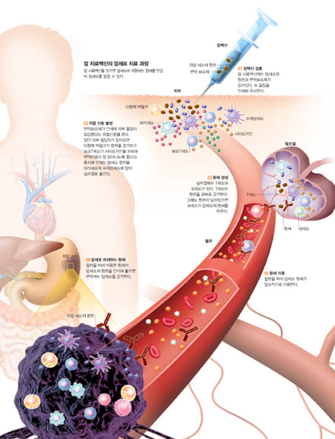 암 치료백신의 암세포 치료 과정^암 치료백신을 맞으면 암세포에 대항하는 항체를 만들 어 암세포를 없앨 수 있다.