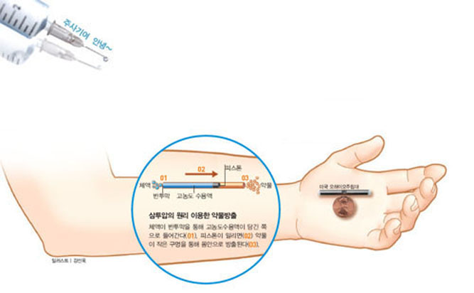 임플란트 약물전달시스템^약물을 접어넣은 매우 작은 장치를 몸속에 삽입한다. 한번 삽입하면 3달 정도 주사를 맞지 않아도 된다.