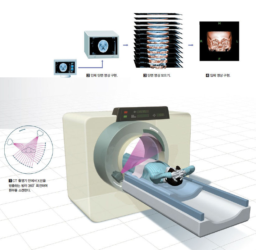 CT의 촬영원리^CT는 인체 부위마다 X선을 투과하는 양이 다른 성질을 이용해 인체의 단면을 영상으로 구현한다. CT 촬영기 안에서 X선을 방출하는 빔이 360。회전하며(1) 인체의 단면을 만든다(2). 컴퓨터는 단면을 모아(3) 입체 영상으로 재구성한다(4).