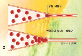 정상적인 적혈구는 좁은 모세혈관을 쉽게 통과하지만(위) 변형능이 떨어진 적혈구는 통과하지 못한다(아래).