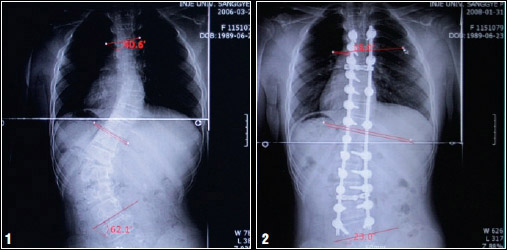 척추측만증 환자의 수술 전후 X선 사진. 척추가 S자형으로 약 60°휜 환자(1)는 척추측만증 수술을 받은 뒤 척추의 휜 각도가 많이 줄었다(2).