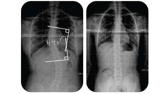 척추의 두 부분에 직각 표시를 했을 때 교차하는 지점의 각도가 척추가 휜 정도이다. 유진이의 척추 X-ray 사진. 약간 휘었지만 걱정할 정도는 아니다.