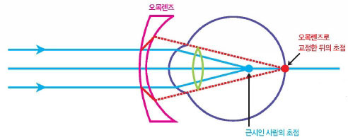 오목렌즈의 근시교정 원리^근시는초점이 망막 앞에 맺힌다. 오목렌즈를 끼면 초점이 뒤로 밀려 망막에 정확하게 맞는다.