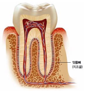 인공 치아를 심으려면 잇몸뼈가 튼튼한 상태여야 한다.