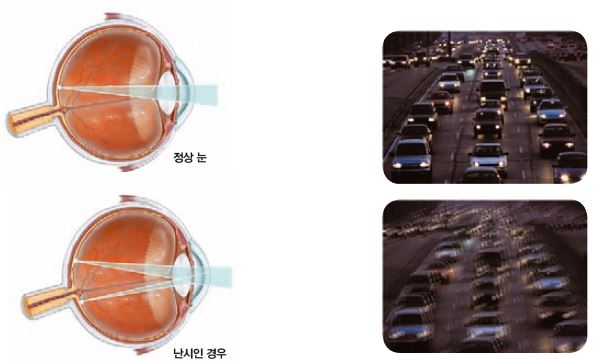 난시와 원주렌즈