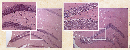 뇌에 생긴 베타아밀로이드 플라크 때문에 뇌세포가 사멸한 알츠하이머 쥐의 뇌(왼쪽)와 톡소포자층의 감염으로 베타아밀로이드 플라크 생성이 억제돼 뇌세포가 살아 있는 알츠하이머 쥐의 뇌(오른쪽) .